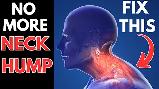 How to FIX the Hump on the Back of Your Neck