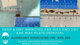 DEEP DRY IMPACTED EAR WAX REMOVAL AND DRY EAR WAX PLATE REMOVAL - EP 389