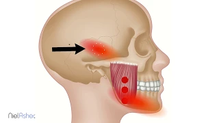 How To Find Trigger Points - Masseter (Jaw and Ear Pain)