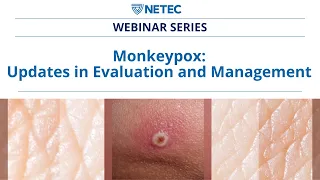 NETEC: Mpox - Updates in Evaluation and Management