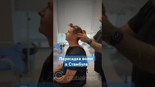 Пересадка волос в Стамбуле с гарантией результата 🔥🔥 #пересадкаволосвтурции #пересадкаволос