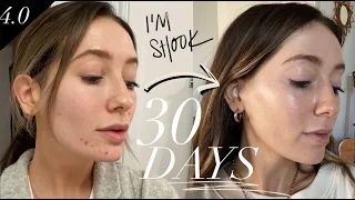 How I cleared my hormonal acne in 30 days | Supplements I take!