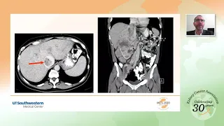 Imaging for Locally Advanced RCC (Node and Thrombus)