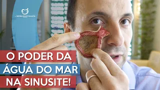 O Poder da ÁGUA do MAR, na SINUSITE!