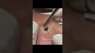 Dr Pimple Popper's Most Popular Pop #shorts