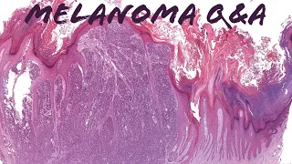 Melanoma Pathology Q&A Discussion: Immunostains, Excision Specimens, Nodal Nevus & More