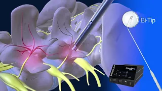 Endoscopic Facet Denervation Animation