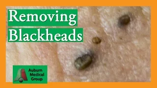 Several Blackheads | Auburn Medical Group