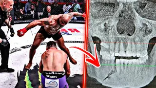 (IMAGENS F0RTES) Lutador do Bellator mostra Raio-X da mandíbula, após nocaute de Yoel Romero!