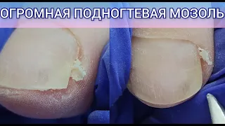 ОГРОМНАЯ ПОДНОГТЕВАЯ МОЗОЛЬ В МАКРО 😱 Как убрать подногтевую мозоль подробно. Почему болят ногти?