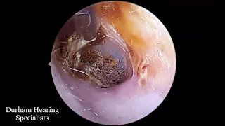 Earwax pressing on the eardrum extracted using suction