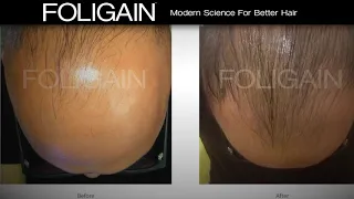 FOLIGAIN High Performance Hair Solutions