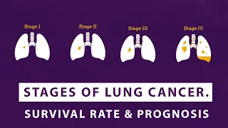 Stages of Lung Cancer. Survival rate & Prognosis. | Episode 5