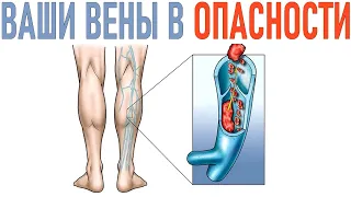 ТРОМБОЗ ГЛУБОКИХ ВЕН | Когда грозит смертельная опасность