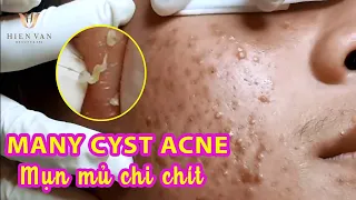 Many Cyst Acne | Điều trị mụn nang, mụn bọc hiệu quả TPHCm |Hiền Vân Spa|565