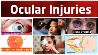 Ocular Injuries 6(Last) Major: Blow out Fracture