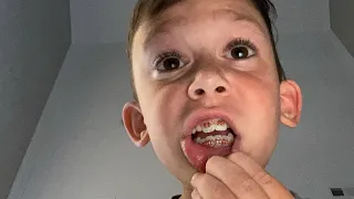 Showing braces beatboxing with braces and more