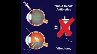 EVS - Endophthalmitis Vitrectomy Study