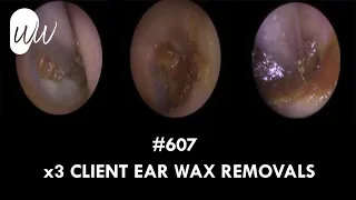 607 - x3 Client Ear Wax Removals