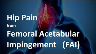 Hip Pain from Femoral Acetabular Impingement (FAI) - What is it and how to treat it?