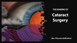 The Making of Cataract Surgery: Phacoemulsification