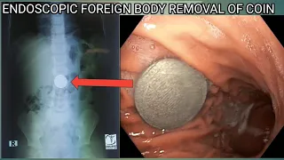 Pediatric Stomach Foreign Body Removal of Coin #BD_ENDOSCOPY