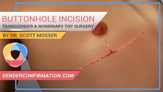 Transgender & Non-binary Buttonhole or Inverted T Incision by Dr. Scott Mosser