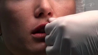 Коррекция ассиметричных губ