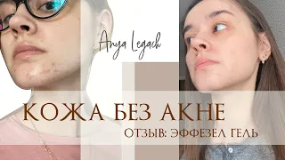 ЭФФЕЗЕЛ: крем ОТ АКНЕ | ОПЫТ ИСПОЛЬЗОВАНИЯ | ДО и ПОСЛЕ ФОТО