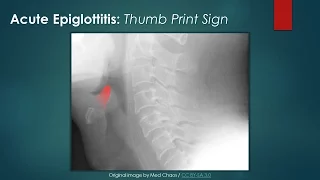 Acute Epiglottitis: Thumb Sign