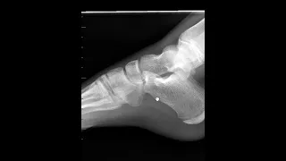 X-ray versus MRI for bone injury