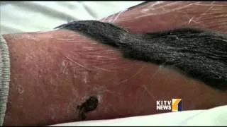 Big Island man treated for flesh eating bacteria