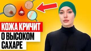 Как КОЖА КРИЧИТ о высоком сахаре