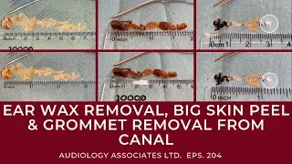 EAR WAX REMOVAL, BIG SKIN PEEL & GROMMET REMOVAL FROM CANAL - EP 204