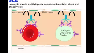 Systemic Lupus erythematosus (SLE)  2016