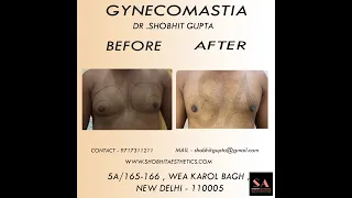 Gynecomastia Before and After Results | Dr. Shobhit Gupta #beforeandafter #Gynecomastia #results