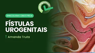 Fístulas urogenitais | Cortes de aula: Ginecologia e obstetrícia