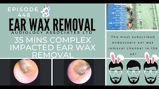 35 MINS COMPLEX IMPACTED EAR WAX REMOVAL - EP449