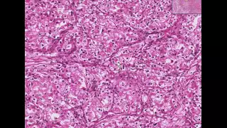 Kidney Renal cell carcinoma hypernephroma