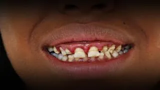 Woman Who Never Lost Her Baby Teeth