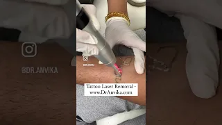 Get rid of your old tattoos with our painless laser tattoo removal #shorts