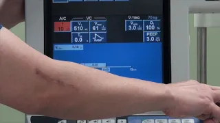 Basics of Mechanical Ventilation and Introduction to PB 840 Ventilator