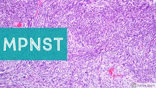 Malignant Peripheral Nerve Sheath Tumor (MPNST) 101...Explained by a Sarcoma Pathologist