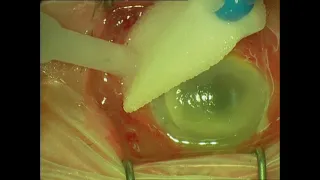 Corneal Sampling, Vitreous Tap and Intravitreal Antibiotic Injections for Panophthalmitis