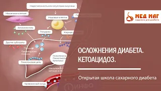 Осложнения диабета. Кетоацидоз.