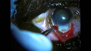 Incision and Paracentesis---WD