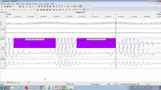 Natus PSG Webinar: Case Study Scoring Respiratory Events