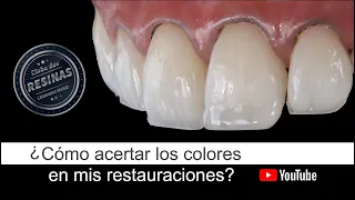 ¿Cómo acertar los colores en mis restauraciones de resinas compuestas?