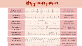 Норма и патология на ЭКГ: Нарушения Ритма