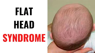 FLAT HEAD SYNDROME: Symptoms, Causes, Prevention